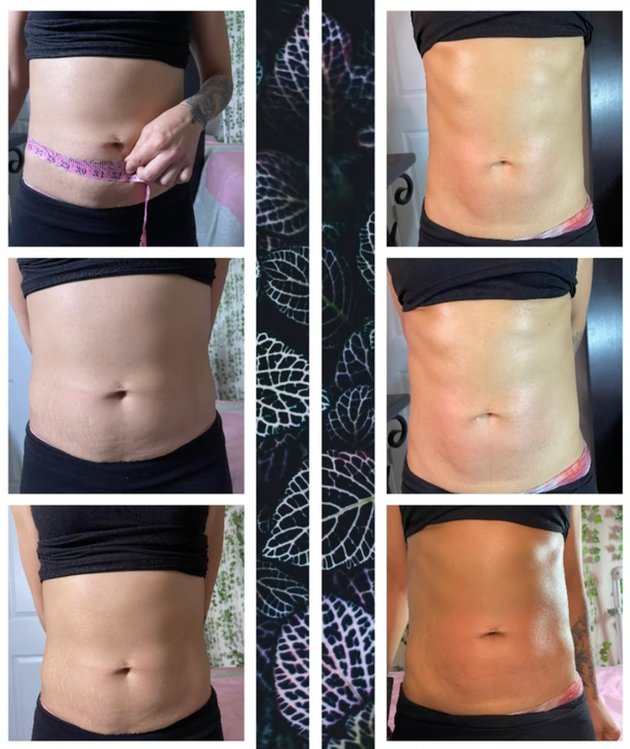 Treatments to Sculpt Your Body: Is Liposuction or Coolsculpting an